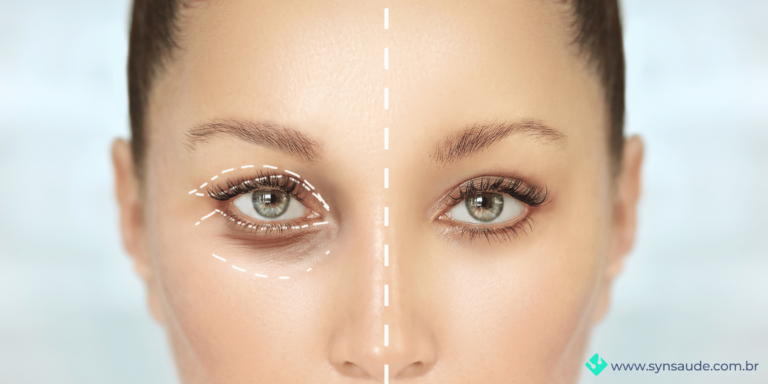 imagem que mostra a correção feita pela cirurgia de blefaroplastia para correção de ptose